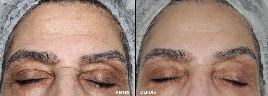 Antes e Depois dos procedimentos