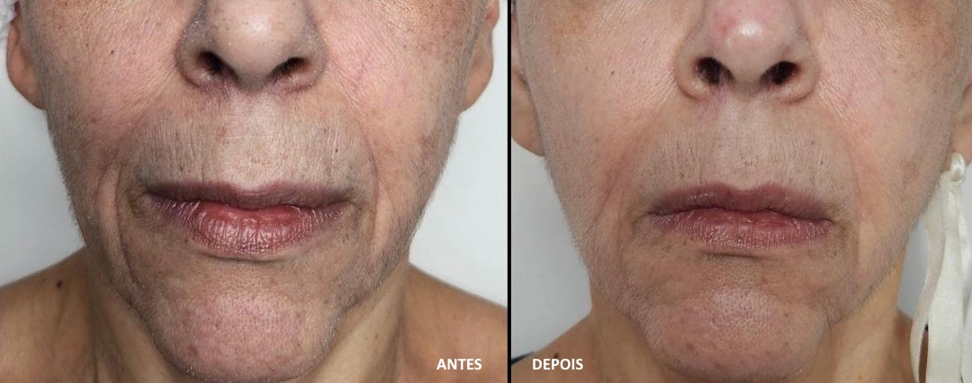 Antes e Depois - Peeling Clareador